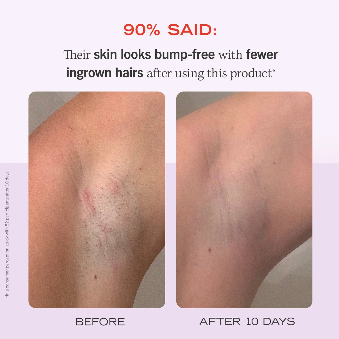 High Roller Ingrown Tonic